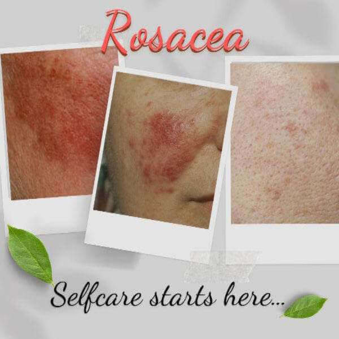 organic facial wash for rosacea